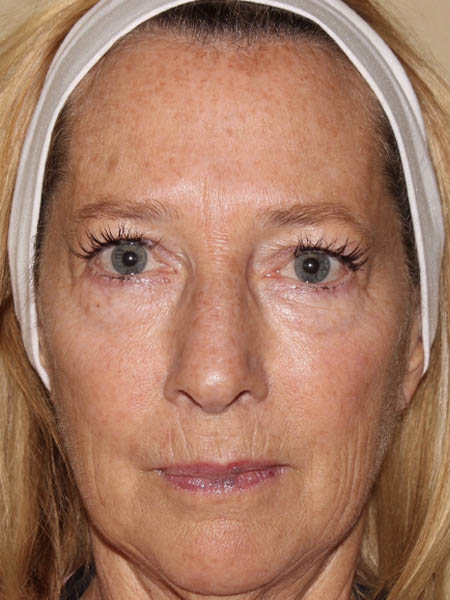 BBL Photorejuvenation