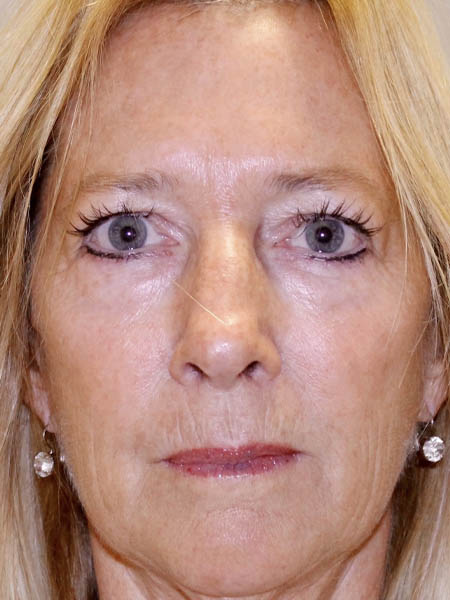 BBL Photorejuvenation