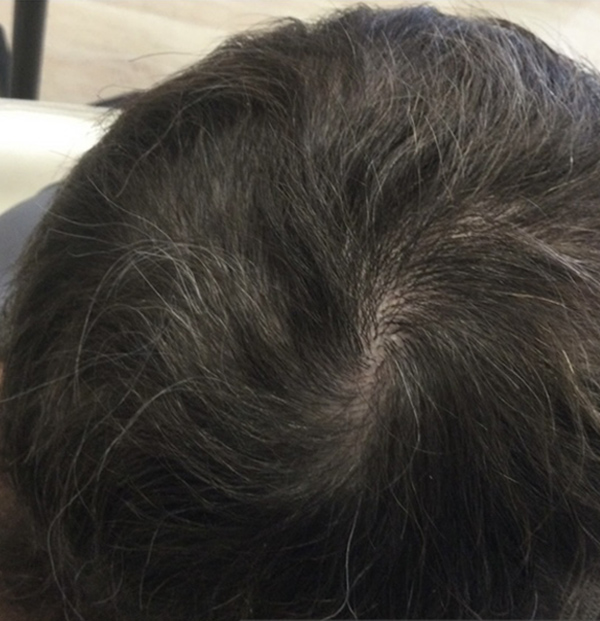 PRP Hair Restoration