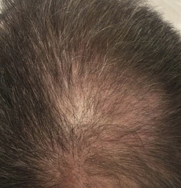 PRP Hair Restoration