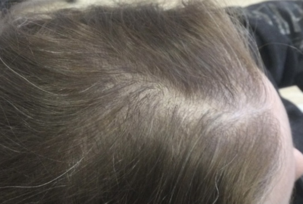 PRP Hair Restoration