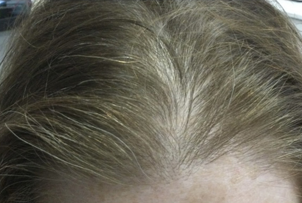PRP Hair Restoration
