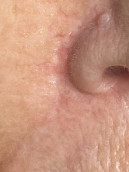 BBL Photorejuvenation