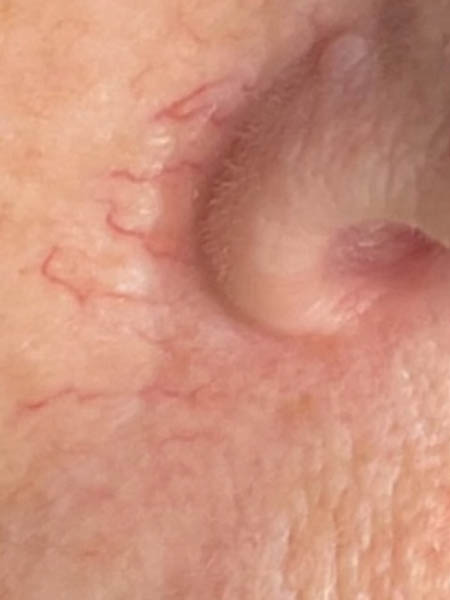 BBL Photorejuvenation