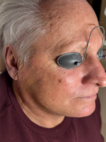BBL Photorejuvenation