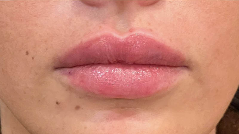 Lip Fillers