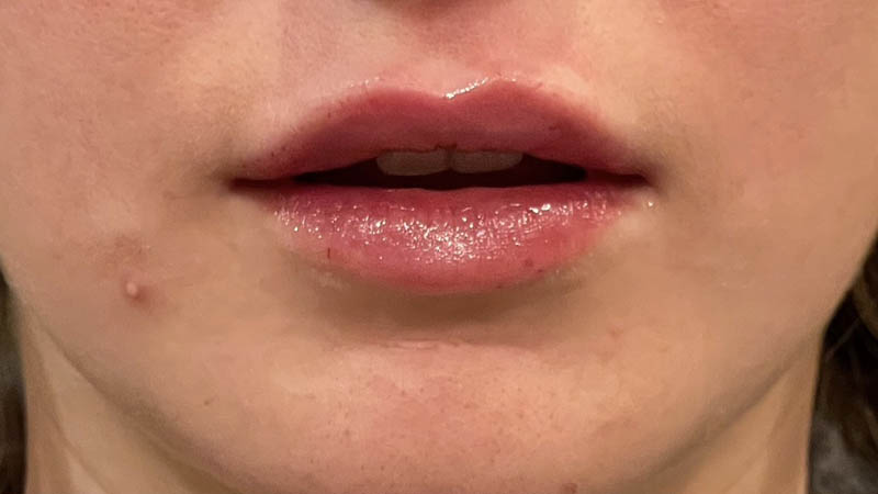 Lip Fillers