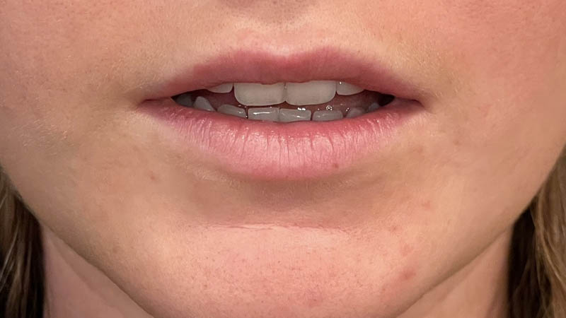 Lip Fillers