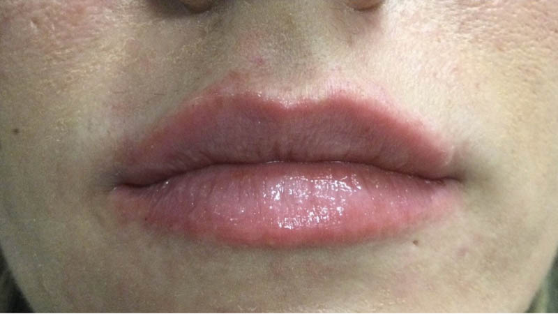 Lip Fillers