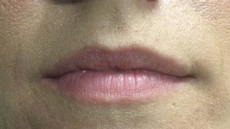 Lip Fillers