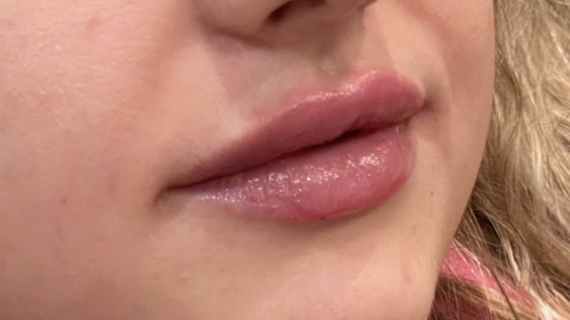 Lip Fillers