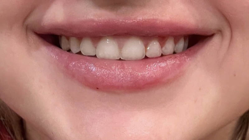Lip Fillers