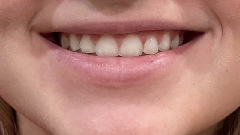 Lip Fillers