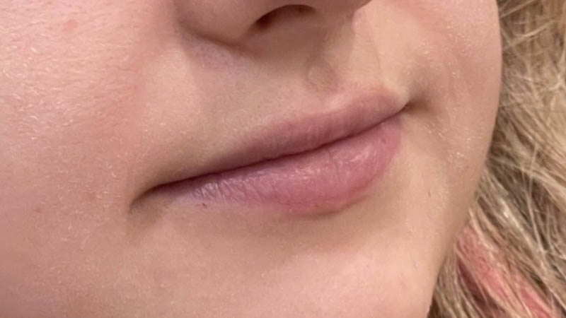 Lip Fillers
