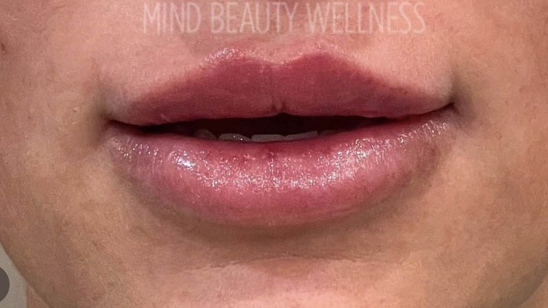 Lip Fillers