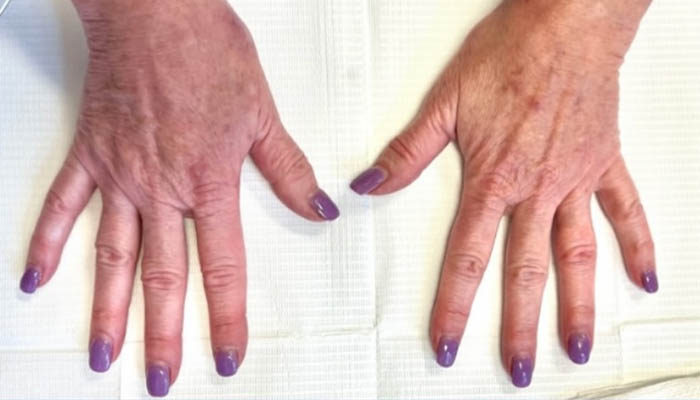 Hand Rejuventation