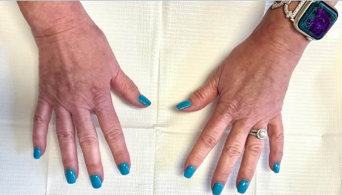 Hand Rejuventation