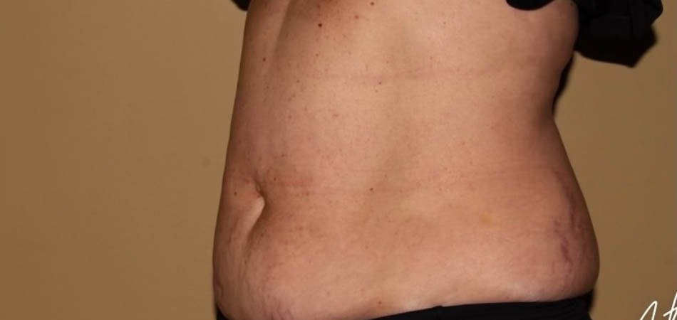 Exilis