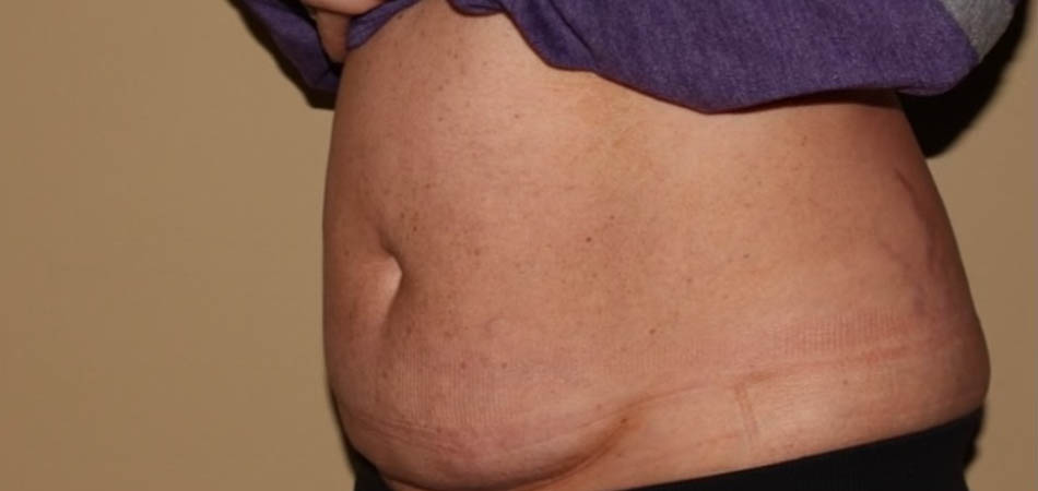 Exilis